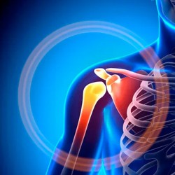 Tendinitis
